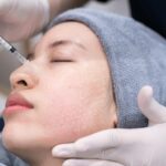 Micro-Needling