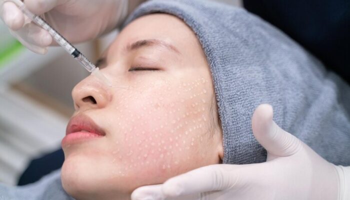 Understanding Micro-Needling: A Treatment for Younger Looking Skin